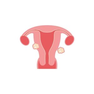 Fibroids: Causes, Symptoms, and Treatments