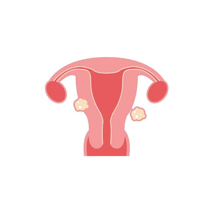 You are currently viewing Fibroids: Causes, Symptoms, and Treatments